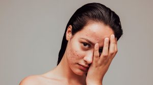 tratamientos para el acné_clínica dermatológica isela méndez¿Buscas tratamientos para el acné? Aquí te explicaremos un poco sobre por qué este problema requiere de una atención especializada. ¡Averigua cuáles son!