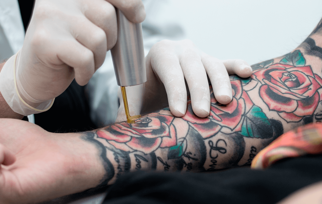¿Ganas de quitarte tus tatuajes? Aquí te explicaremos por qué el retiro de tatuajes con técnica láser es una de las mejores opciones para ti. Retiro de Tatuaje_clínica dermatológica isela méndez