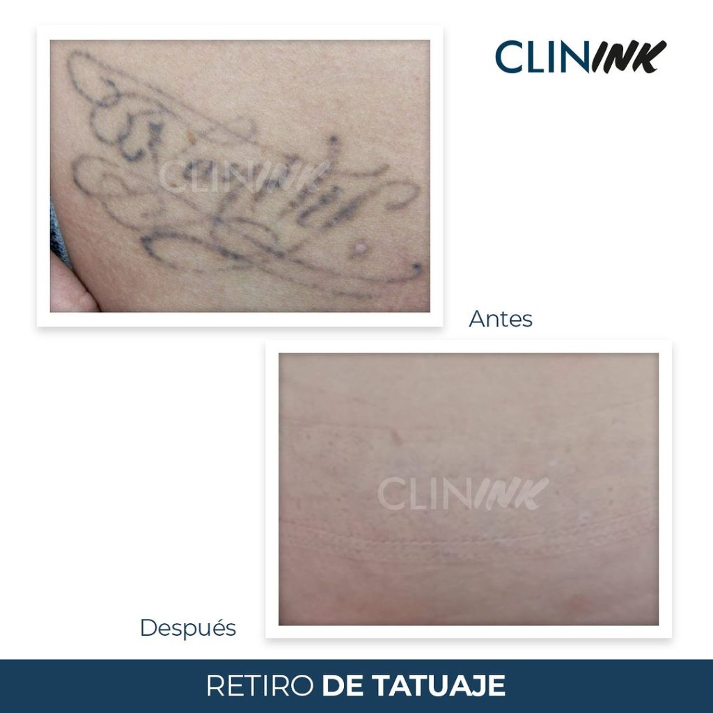 retiro de tatuaje_clínica dermatológica isela méndez Algunos resultados sobre cómo luce un retiro de tatuaje.