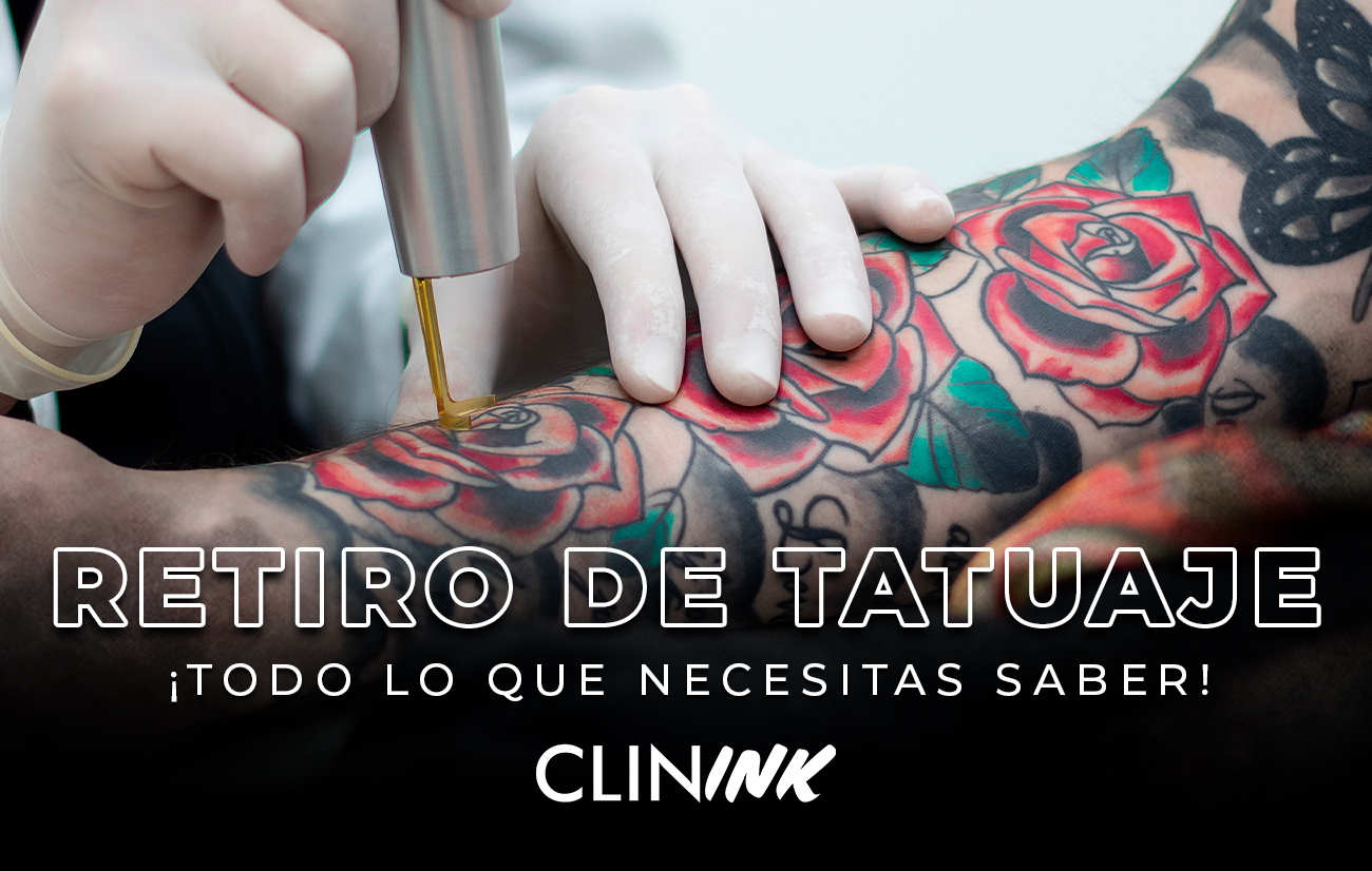 retiro de tatuaje_clínica dermatológica isela méndez ¿Cómo se cobra un retiro de tatuaje? ¿Cuánto tiempo puede durar este tratamiento? Estas preguntas, y otras no menos frecuentes, las hemos respondido para ti.