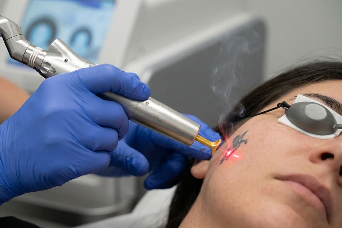 Proceso de consulta para aclarado de tatuajes de colores con laser